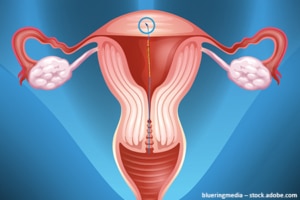 Einsetzen GYN-CS Kupfer-Spirale Verhütung nach Kaiserschnittgeburt